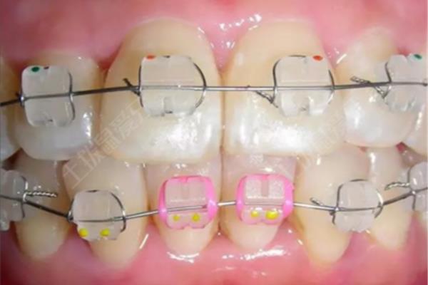 牙齒多久會反彈嗎