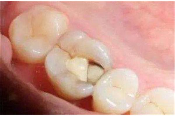 補個牙洞能保持多久