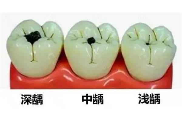 樹脂補牙壽命多久