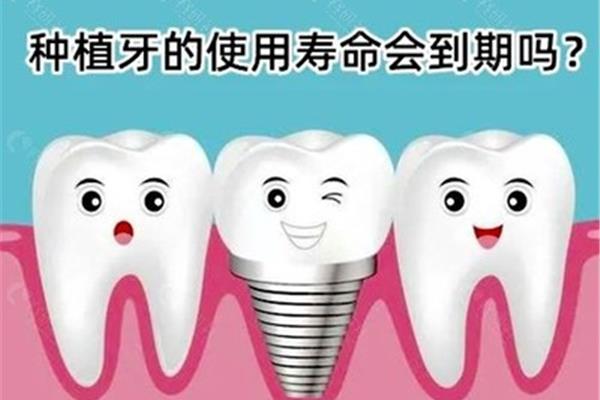 種牙的過程需要多久? 單顆種植牙能用多久