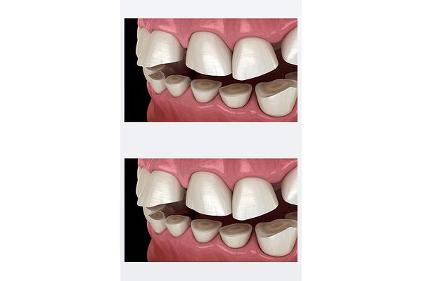牙齒怎么磨損的原因 牙磨牙 多長時間