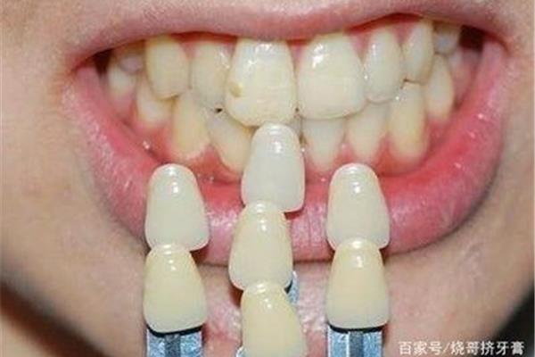鑲一顆牙齒能用多久