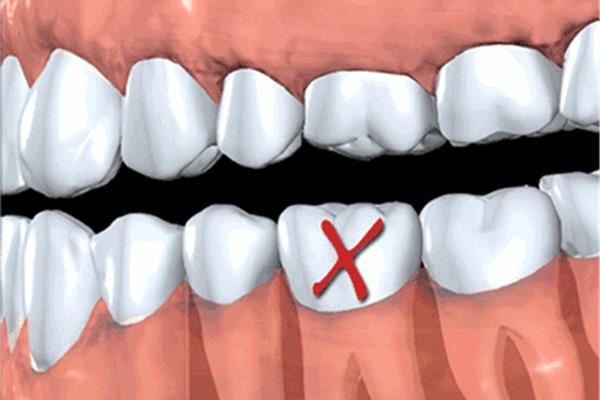 拔牙后多久可以鑲牙?一般1個月左右牙槽骨基本愈合
