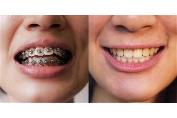 牙齒矯正要如何進行? 種牙二次手術要多久