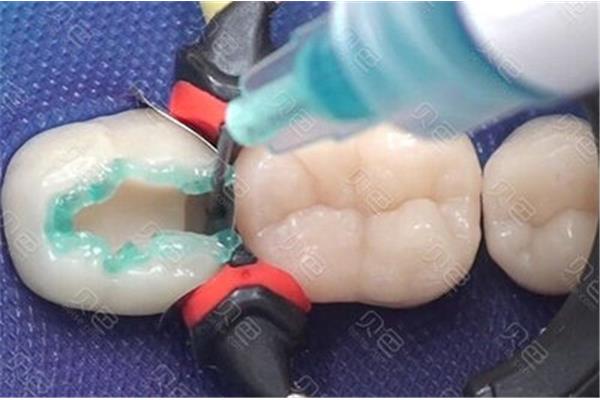 光固化樹脂補牙使用年限因個人護理措施等影響