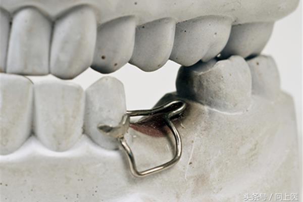 兒童金屬牙冠能用多久