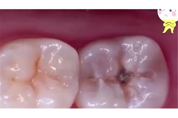 補牙保質期多久?如何補牙?