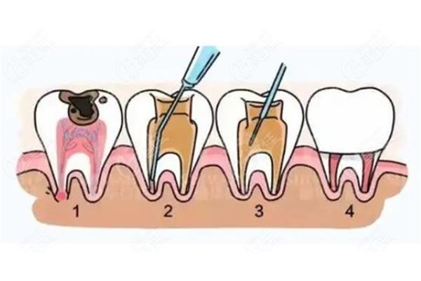 正畸治療:先拔根再做牙修復就是戴牙套