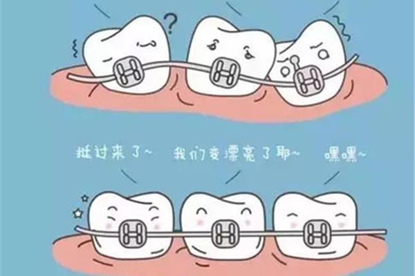 帶牙套一次復診后一定要再去復診嗎?