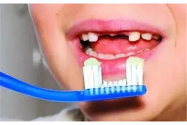 拔牙后多久可以刷牙嗎