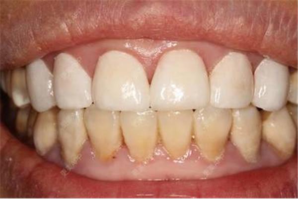 牙齒貼面可以維持多久?答案是否有必要?