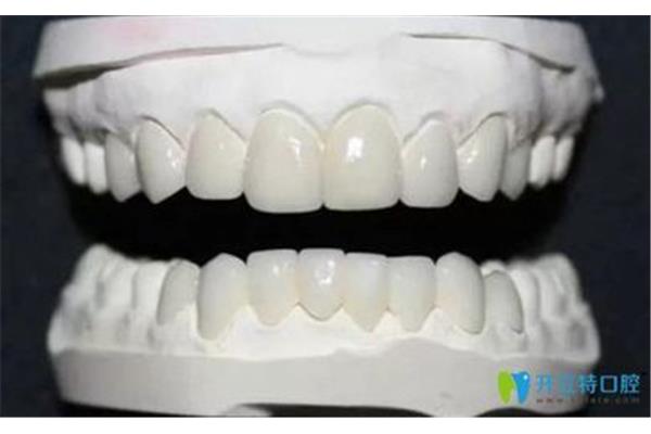 牙齒瓷貼面能維持多久