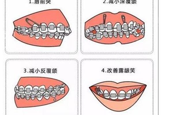 牙齒矯正多久需要收緊一次,成年人矯正牙齒需要多久?