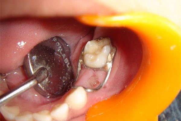 拔完牙齒多久能補牙?一般來說兩個月內可恢復