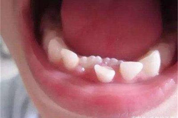 小孩子換牙多久長出新牙? 掉一顆牙多久能長出來