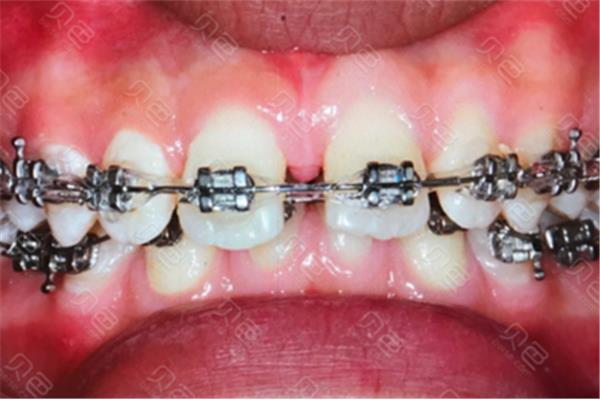 戴牙套會疼多久? 牙齒矯正后會疼多久