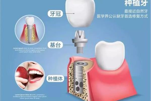 人工種植牙的過程 種牙多久裝牙冠