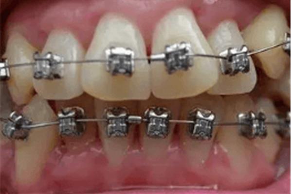 成年人牙齒不齊需要多久矯正