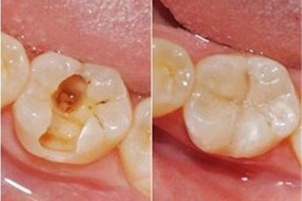 補牙需要多久?點擊咨詢在線牙醫專業解答