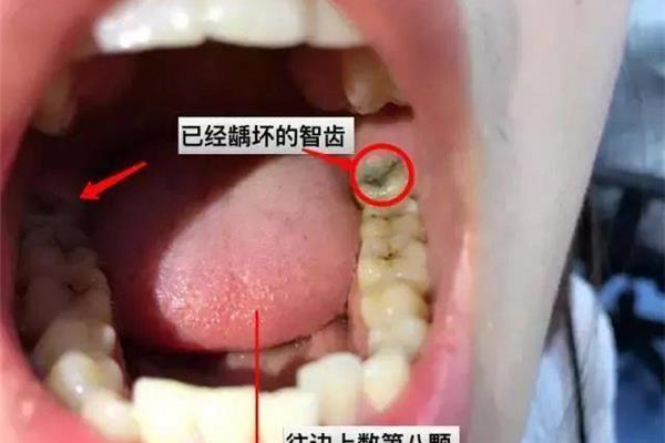 牙痛多久能治好,急性牙髓炎多久能自行緩解?
