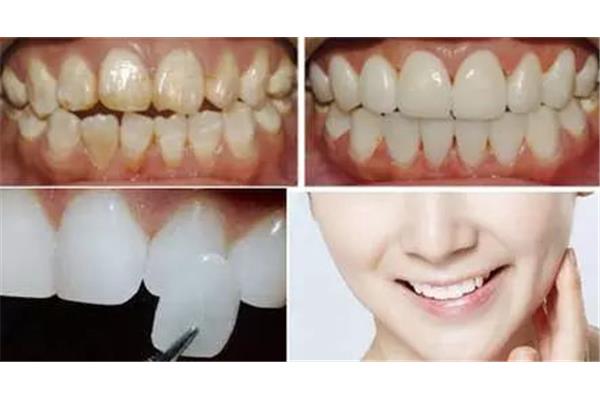 牙齒貼面可以維持多久? 牙齒做貼片能保持多久