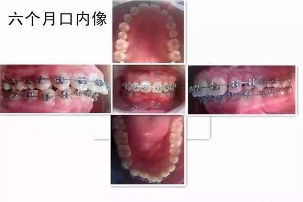 牙齒矯正意義重大建議去專業牙科醫院