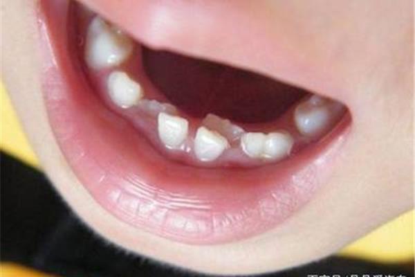 小孩正畸牙齒要多久