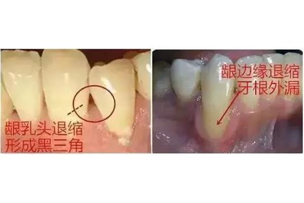 牙齦出血怎么回事? 拔牙牙齦撕裂多久會好