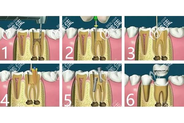 根管治療的牙齒能用多久