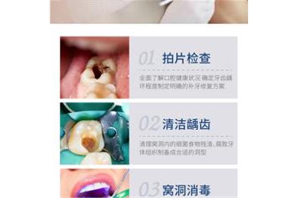 補牙后如何保護牙齒? 補牙要多久