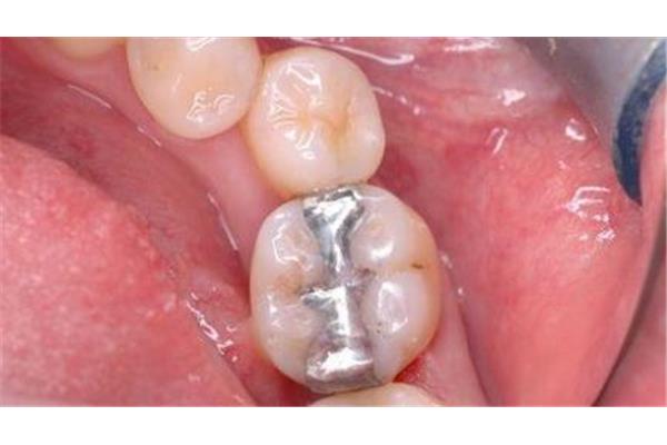 補過的牙能用多久? 銀梗合金補牙能用多久