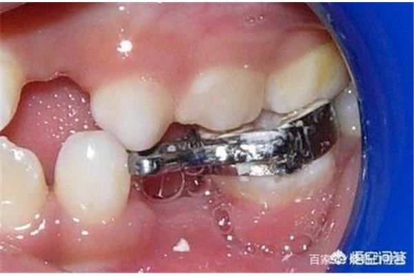孩子乳牙松動能拔嗎? 兒童牙齒松動多久換牙