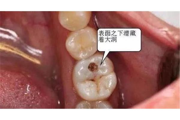 補過牙齒能使用多久? 牙齒有洞,補牙后能用多久?