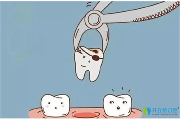 拔牙齒后多久能恢復?一般需要三天