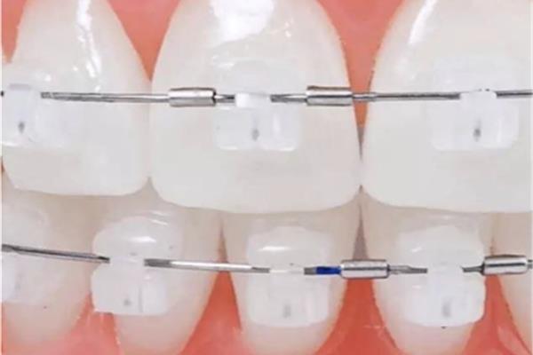 牙齒矯正要花多長時間 正頜術后正畸要多久