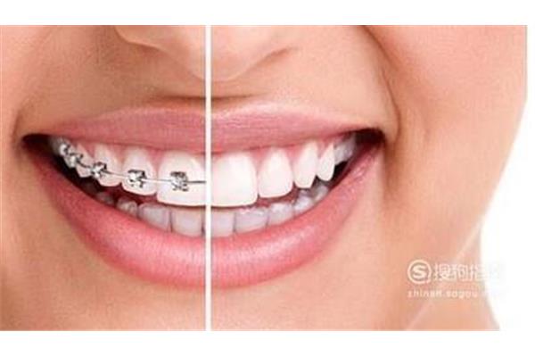 成年人牙齒矯正需要多久?專家:與采用方法有關
