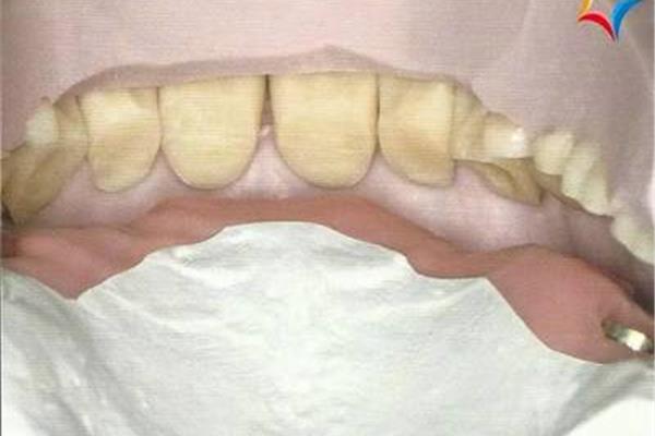 裝固定假牙要多久