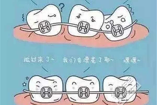 牙齒保持器多久換一個