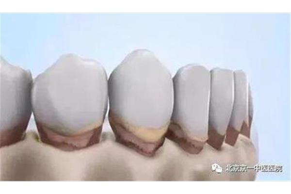 牙齦萎縮能活多久