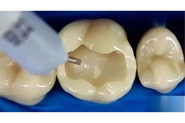 嵌體和補牙之間的區別 高嵌體補牙能維持多久