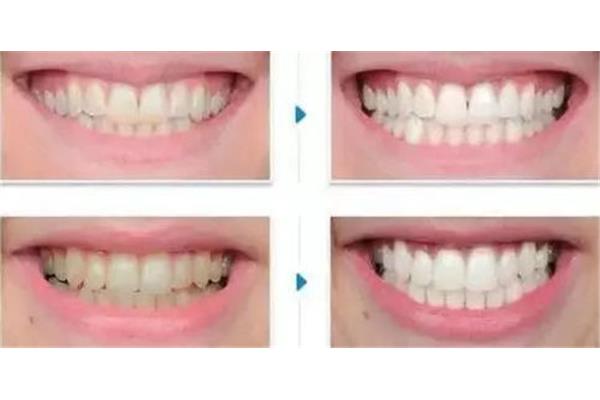 牙齒貼面能用多久?siroduce:可以維持長期的嗎?