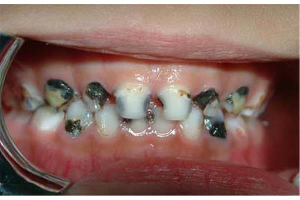 如何治療蛀牙? 治蛀牙要多久