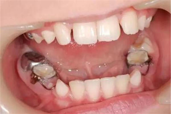 牙齒拔掉的壞處 拔完牙多久牙齒會移位