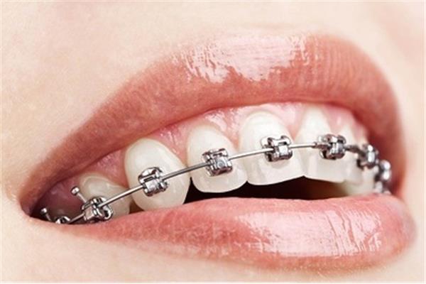 牙齒矯正需要多長時間?一般需要一年