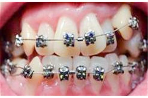 牙齒矯正需要戴保持器多久?
