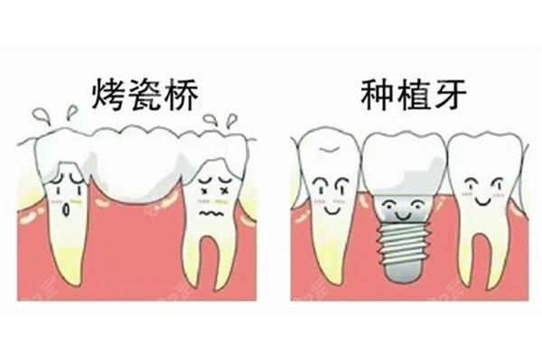 口腔健康日益重要假牙套能帶多長時間?
