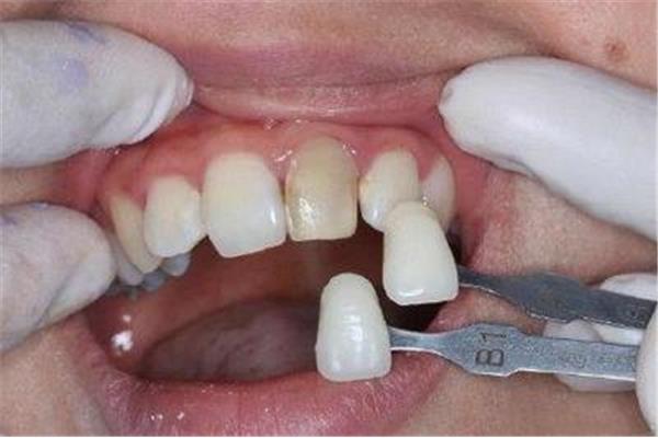 牙齒磕了怎么會變色? 牙外傷后多久牙齒變色
