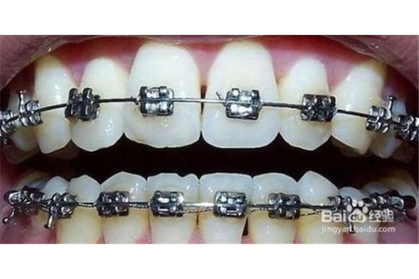 牙齒矯正過程如何進行? 矯正牙齒需要多久