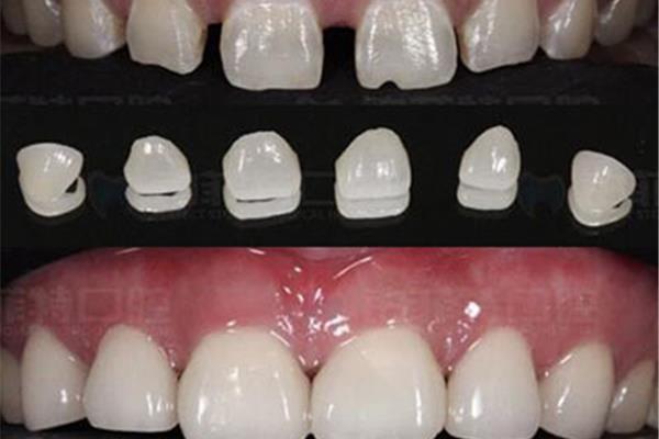 全瓷牙的使用壽命有多長? 種植一顆全瓷牙能用多久