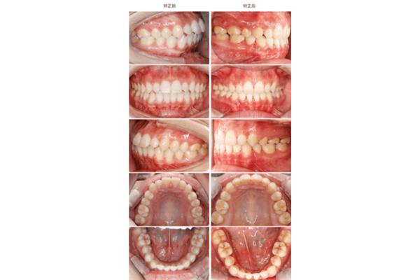 整牙做牙套要多少錢,對以后的牙齒有影響嗎?